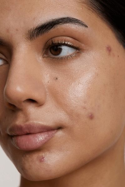 Acne/Blemishes