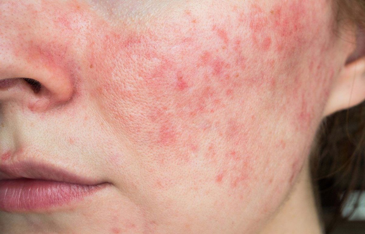 Redness/Sensitivity